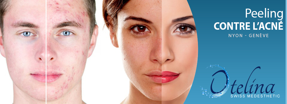 Peelings contre l'acné et les cicatrices Peelings contre l'acné et les cicatrices